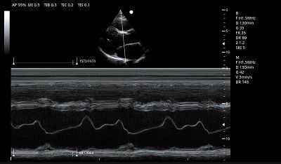 LV Long Axis M Mode(001)